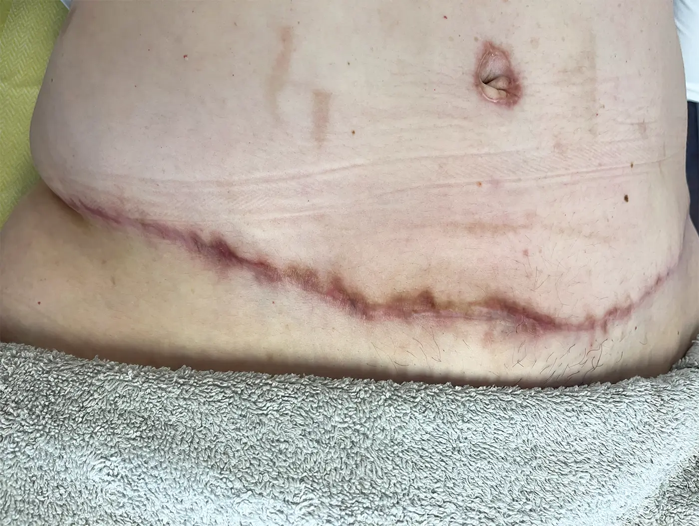 littekenverzorging keizersnede